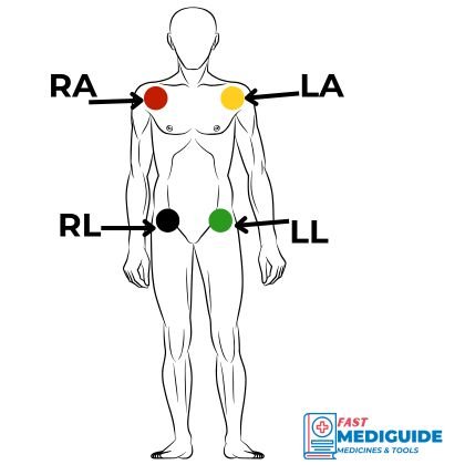 ECG placement alternate places for limb electrodes